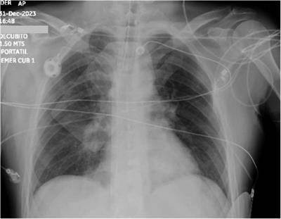 Successful pharmaco-invasive approach using a lower alteplase dose and VA-ECMO support in high-risk pulmonary embolism: case report